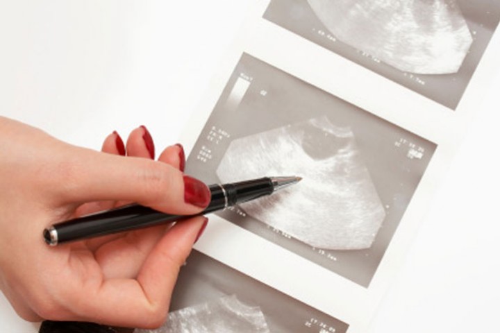 OvarianCancer
