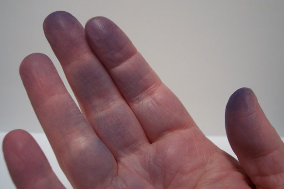 raynaud_