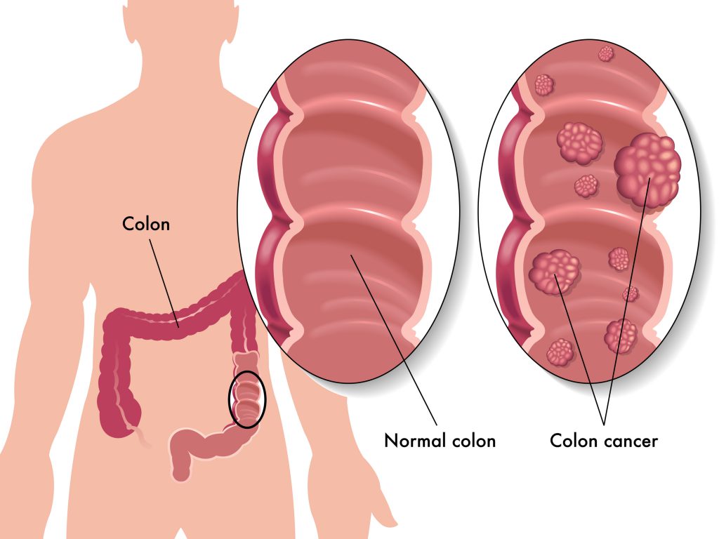 colon cancer