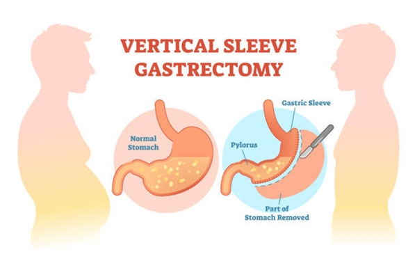 Gastric Sleeve