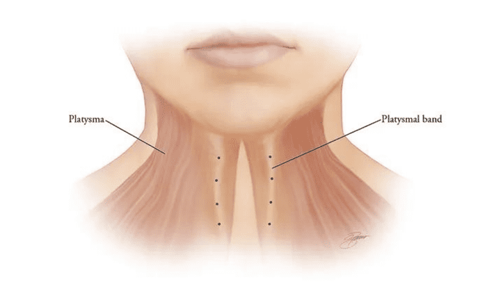 Botox for Platysmal Bands